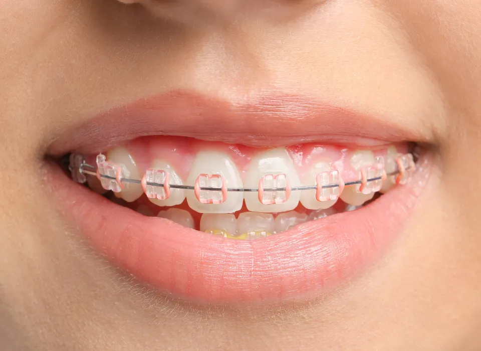 APPAREIL DENTAIRE STANDARD